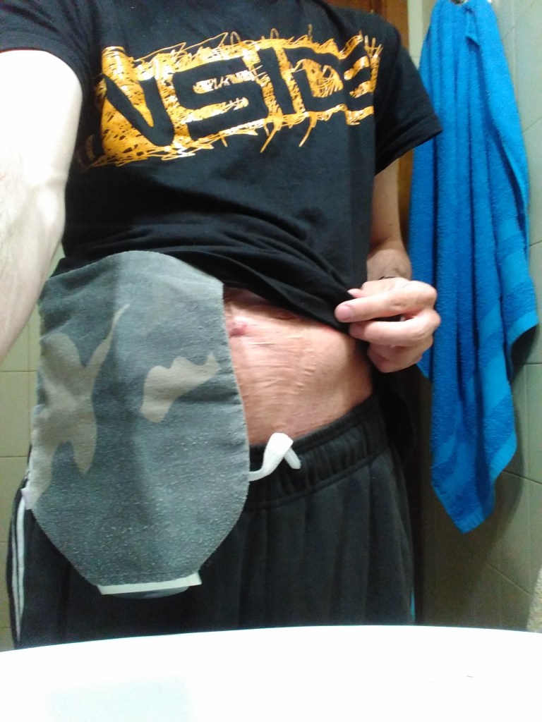 Enseñando ileostomia